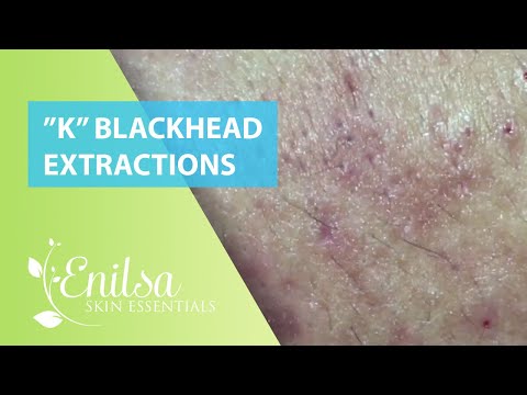 Blackheads Extractions “K’s” 7th Treatment