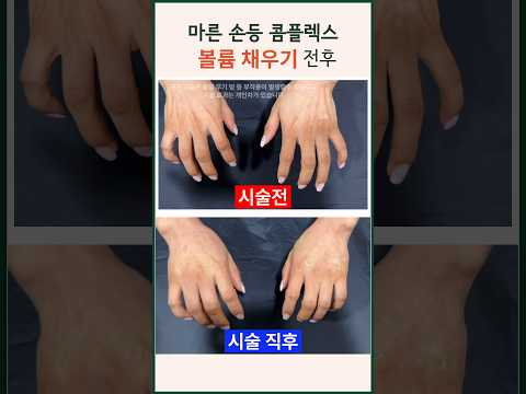 손등 콤플렉스 볼륨 시술 전후 변화 | 필러 특수부위 혈관 마른손등 #modsclinic #손등필러