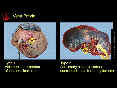 Vasa Previa: Ultrasound Diagnosis