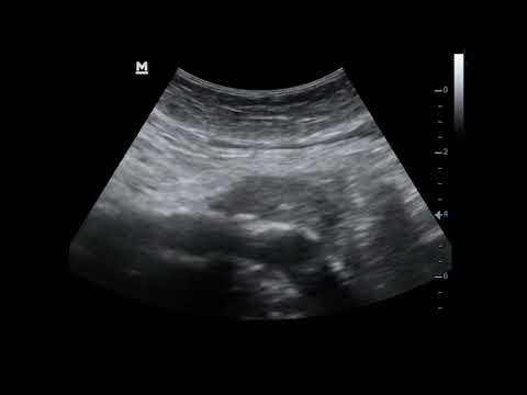 Succesful endovascular treatment of an abdominal aortic aneurysm