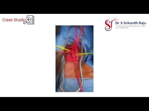 Case Study | Dr.Srikanth Raju | Vascular Surgeon | Hyderabad