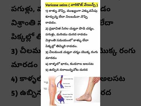 వేరికోసి్  వీన్స్  Varicose veins symptoms in Telugu #shorts #ytshorts #saanvidental #trendingshorts