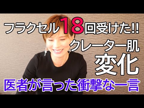 フラクセル18回受けた!クレータ肌の変化と医者の衝撃的な一言