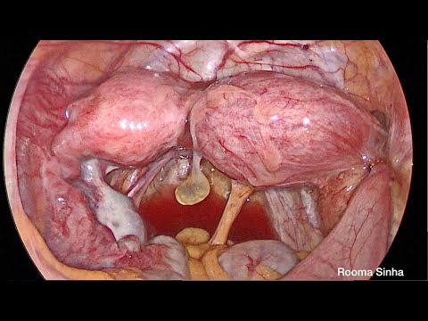 Laparoscopic excision of Functional Right rudimentary uterine horn Dr Rooma Sinha Apollo Hyderabad