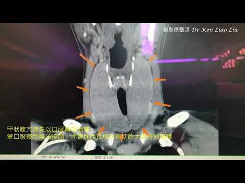 甲狀腺亢進 Graves' disease Hyperthyroidism CT scan