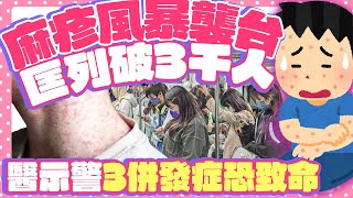 麻疹風暴襲台匡列破3千人 醫示警「3併發症恐致命」 @ChinaTimes