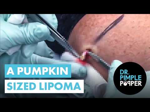 A Pumpkin Sized Lipoma