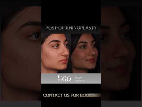 Before and After Rhinoplasty Operation - Dr Guncel Ozturk #drgo #guncelozturk #rhinoplastyturkey