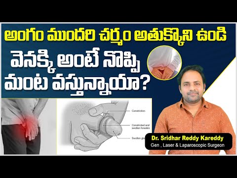 అంగం ముందరి చర్మం || Best Treatment for Phimosis in Telugu || KSR Stapler Circumcision || TRH