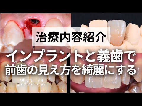 【治療紹介】インプラントと義歯で前歯の見え方を綺麗にする！