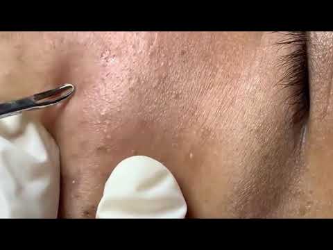 Blackheads Removal By Expert, Milia, Pimple Popper Videos 2019