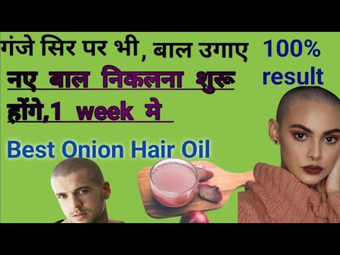 हफ्ते में सिर्फ एक बार लगा लो, बाल बड़ेगे तीन गुना स्पीड से , How to use onion hair oil..