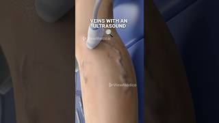 Super glue for your veins? (3D Animation)