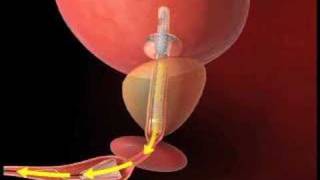 Male Urethral Stent Catheterization