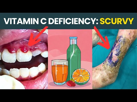 Vitamin C Deficiency Diseases Like Scurvy: Scary Symptoms Explained