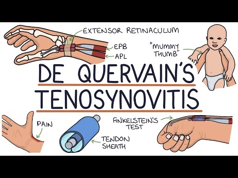 Understanding De Quervain’s Tenosynovitis (Mummy Thumb)