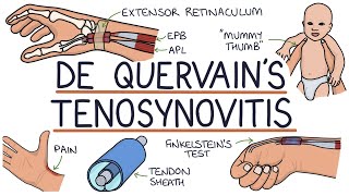 Understanding De Quervain’s Tenosynovitis (Mummy Thumb)