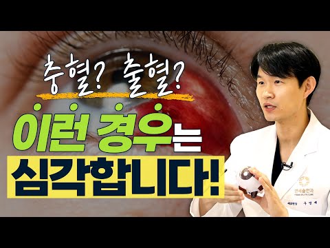 단순 충혈이 아니다? 결막하출혈이 자꾸 반복해서 생긴다면? - 솔직한 안과 #8