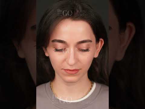 Before and after rhinoplasty images our dear patient