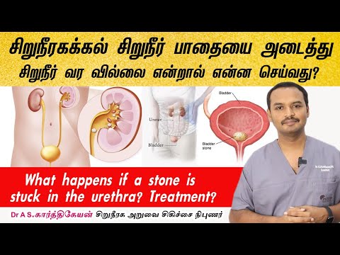 Struck Urethral Calculus treatment? கல் சிறுநீர்பாதையை அடைத்து சிறுநீர் வர வில்லை என்றால் தீர்வு ?