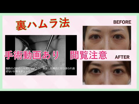 裏ハムラ法の手術中動画とビフォーアフターの経過