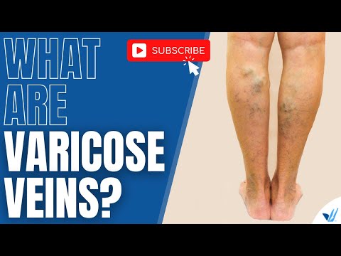 What Are Varicose Veins?