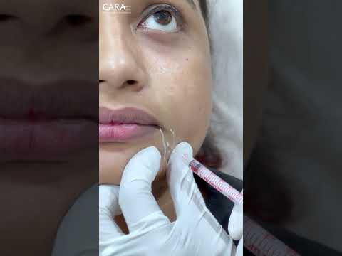 Botox Treatment | Expert Advice and Tips | Cara Clinic