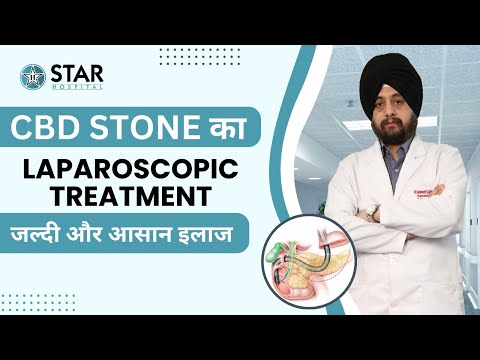 CBD Stone Treatment: ERCP Surgery, Laparoscopic Procedure, Advanced Stone Removal Solutions