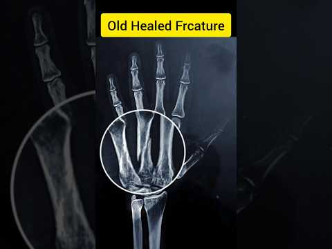 Old Hand Bone Fracture