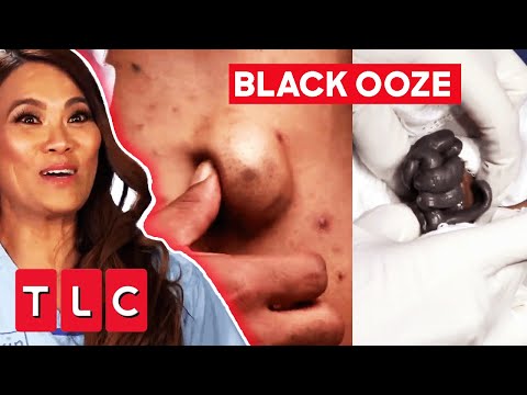 GIANT CYST Expels Thick Black Ooze | Dr. Pimple Popper: This Is Zit!