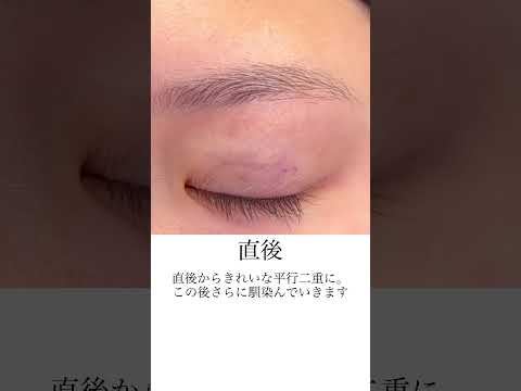 【二重整形】直後からめっちゃきれいで可愛い二重に！！【美の主治医京様】