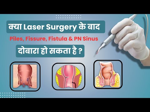 Kya Laser Surgery ke baad PILES, Fissure, Fistula & PN Sinus dobara ho skta hai? | Myth & Facts