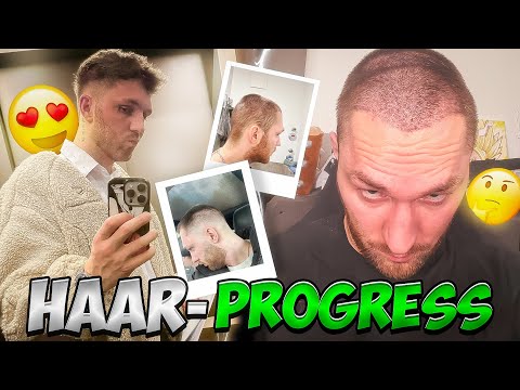 UPDATE ZU MEINER HAARTRANSPLANTATION! 😳 ( Ablauf, Fortschritt & mehr! )