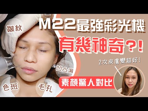 【😱超驚人】M22彩衝光Before & After．頂尖醫療級光學儀器🤩改善皮膚實錄：膠原再生、去紋去黃、收毛孔、去色班.暗瘡.凹凸洞｜點用FDA分優質儀器｜ft. Oneness｜醫學美容｜非廣告