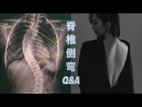 【脊椎側彎Q&A】手術有多痛？術後可以彎腰？為什麼會有脊椎側彎？｜Stephy Yiwen