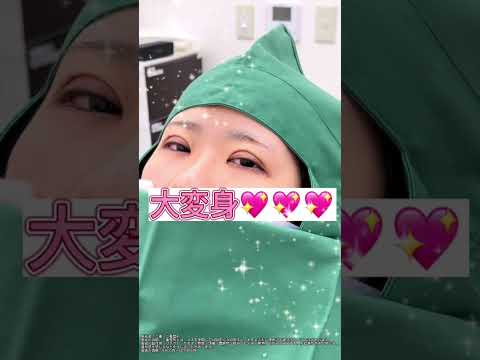 湘南美容クリニック豊田院で大変身💖かわいい二重まふたには簡単に変身できます！　☎️電話番号は0120-324-515 #湘南美容クリニック#湘南美容クリニック豊田院#湘南美容外科#かわいくなりたい