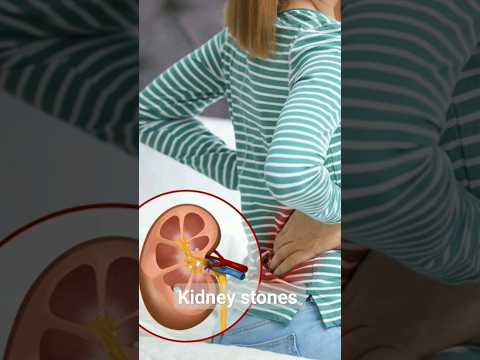 #kidneystone | #kidney_stone_tamil | #kidneystonestamil | #kidneystoneproblems/ #kidneystonesymptoms