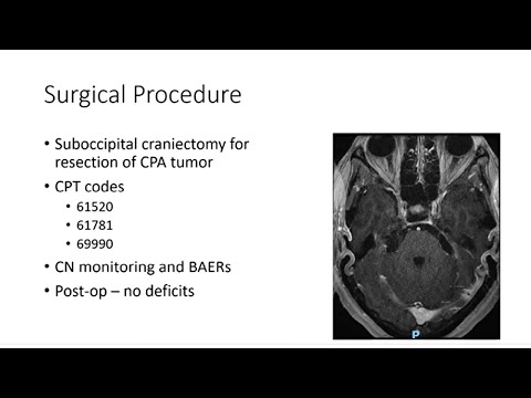 AANS Coding Shorts: Cerebellopontine Angle Tumor Resection