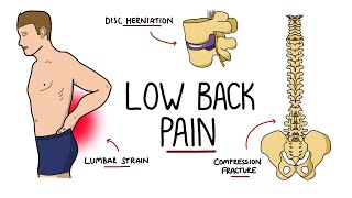 Low Back Pain Explained (Including Red Flags)