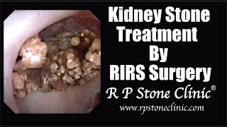 Kidney Stone Treatment by RIRS Surgery