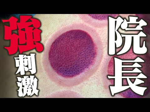 【吸い玉 院長】院長に悶絶吸い玉！院長は寝落ちせずに最後まで吸い玉を受けられるのか！？Cannaでは久しぶりの院長の吸い玉跡は必見です！