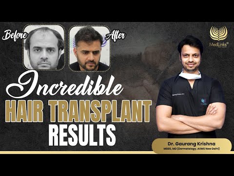 Incredible Hair Transplant Results | Medlinks