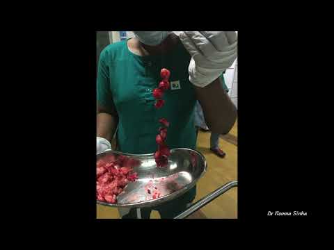 STEPS in Robotic assisted myomectomyFeb 2018