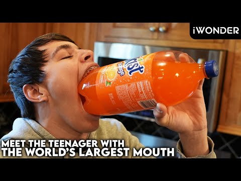 This Teenager Has The World's Biggest Mouth Gape