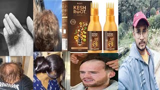 don't use kesh root hair oil | honest review