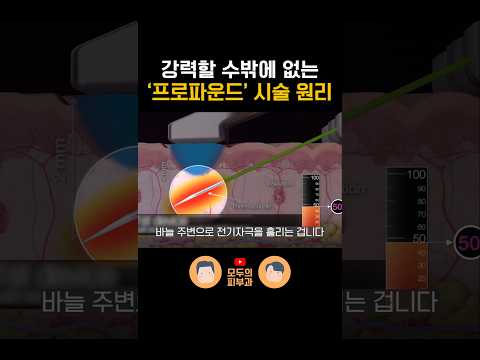 프로파운드와 다른 시술들의 가장 큰 차이점은?｜MTS, 포텐자, 시크릿, 실펌X