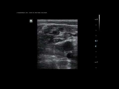 Thrombus at gastrocnemius vein