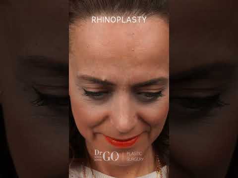 Rhinoplasty Transformation by Assoc. Prof. Dr. Güncel Öztürk | Before & After Results