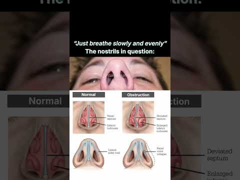 If only there was a solution… #intakebreathing #deviatedseptum #nose #sleep