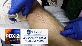 How The New VenaSeal Varicose Vein Treatment Works - SLUCare Health Watch